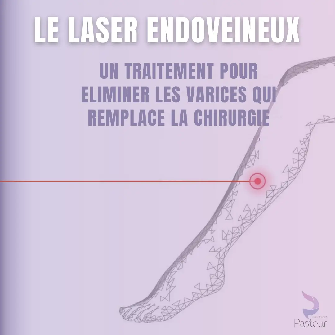 Laser endoveineux